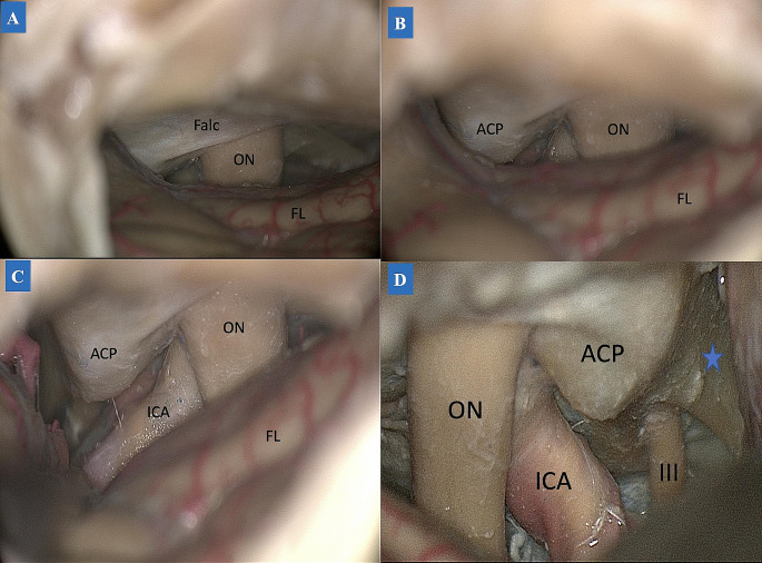 Supraorbital "Eyebrow" Keyhole Craniotomy — Fig. 3