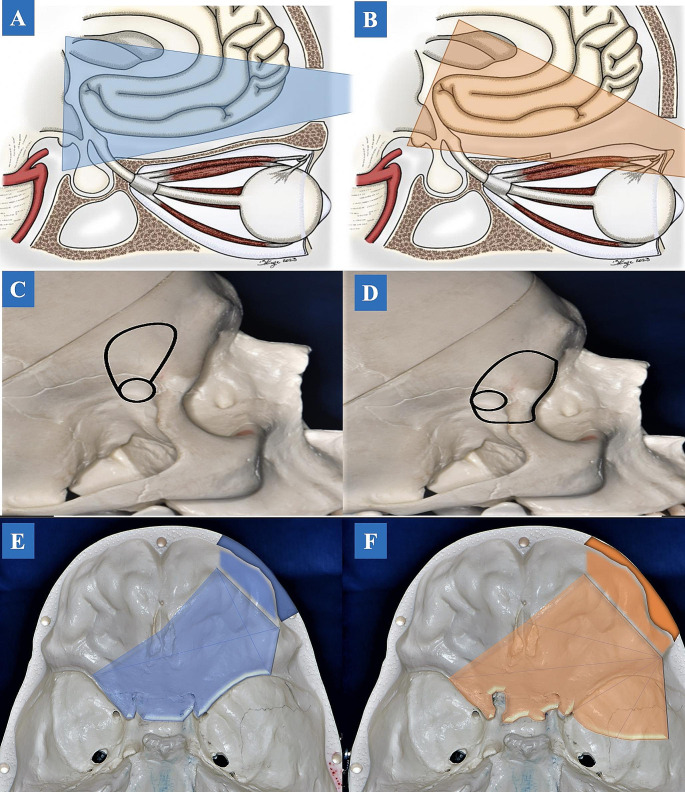Supraorbital "Eyebrow" Keyhole Craniotomy — Fig. 4