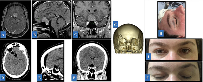 Supraorbital "Eyebrow" Keyhole Craniotomy — Fig. 5