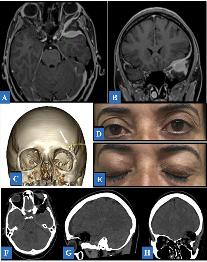 Supraorbital "Eyebrow" Keyhole Craniotomy — Fig. 6