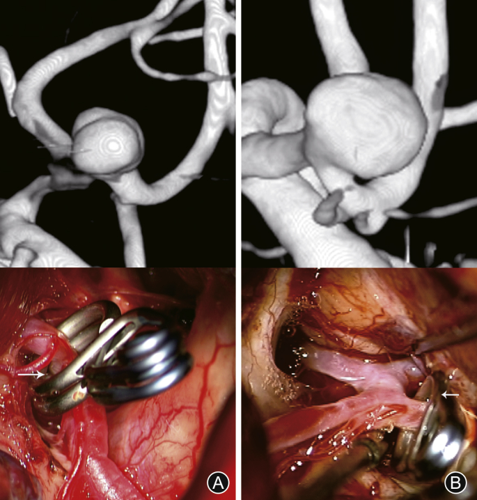Supraorbital "Eyebrow" Keyhole Craniotomy — Fig. 1