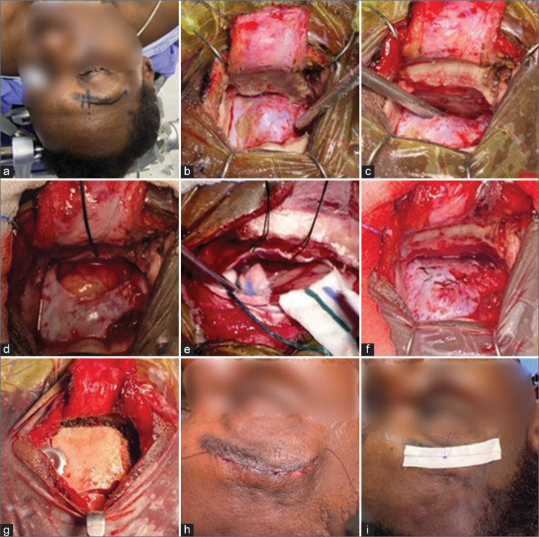 Supraorbital "Eyebrow" Keyhole Craniotomy — Figure 1: