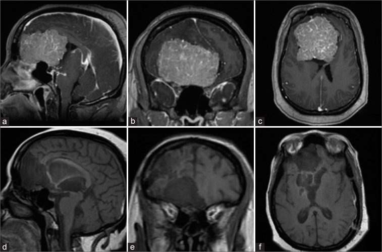 Supraorbital "Eyebrow" Keyhole Craniotomy — Figure 2:
