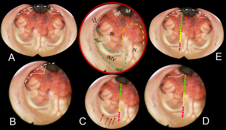 Telovelar Approach Fourth Ventricle — Fig. 3