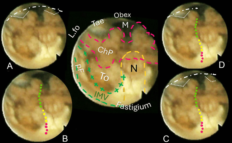Telovelar Approach Fourth Ventricle — Fig. 4