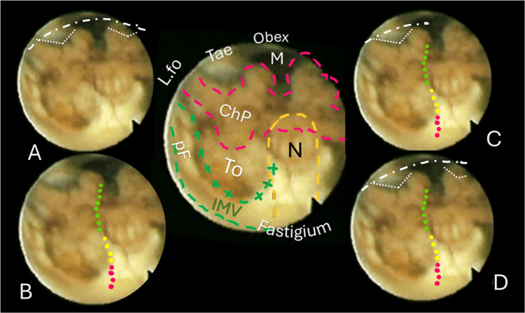 Telovelar Approach Fourth Ventricle — Fig. 5