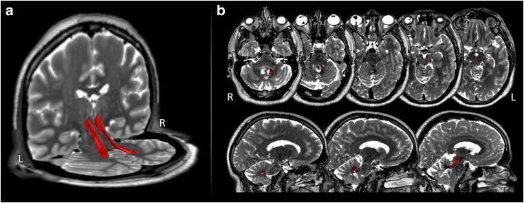 Telovelar Approach Fourth Ventricle — Fig. 3