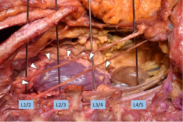 Transpsoas Lateral Approach Lumbar Spine — Figure 1
