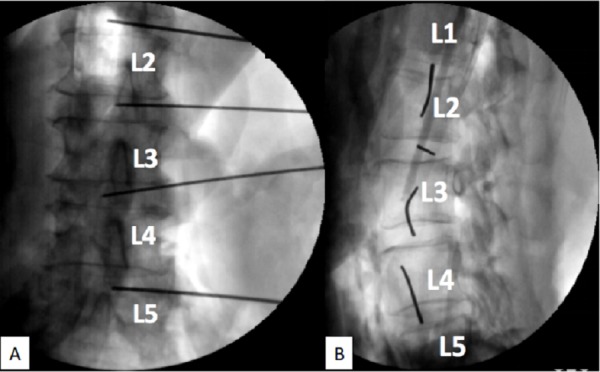 Transpsoas Lateral Approach Lumbar Spine — Figure 2