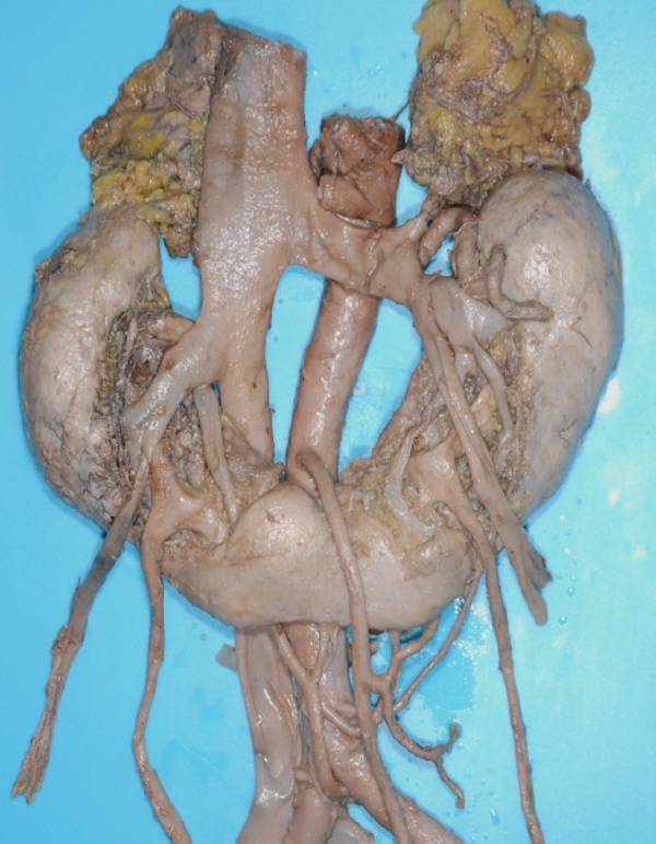 Transpsoas Lateral Approach Lumbar Spine — Figure 3