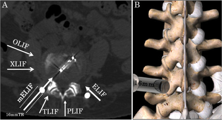 Transpsoas Lateral Approach Lumbar Spine — Fig. 1