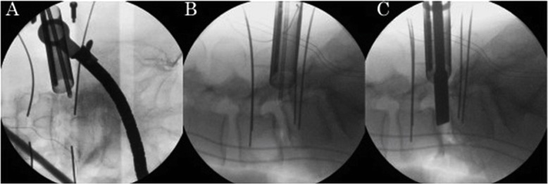 Transpsoas Lateral Approach Lumbar Spine — Fig. 2