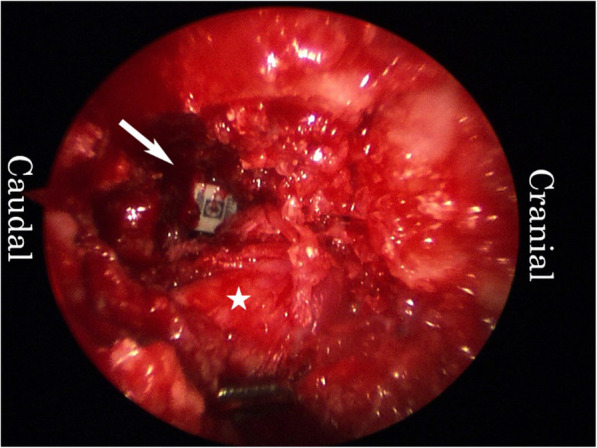 Transpsoas Lateral Approach Lumbar Spine — Fig. 3