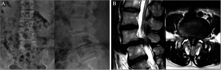 Transpsoas Lateral Approach Lumbar Spine — Fig. 4