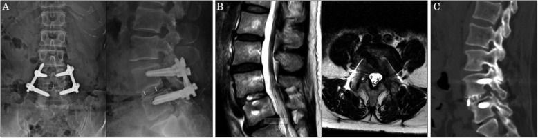 Transpsoas Lateral Approach Lumbar Spine — Fig. 5
