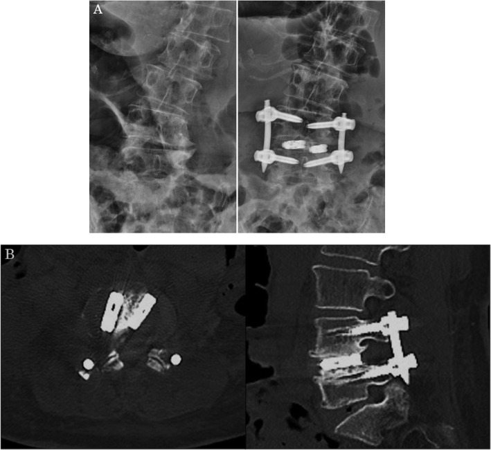 Transpsoas Lateral Approach Lumbar Spine — Fig. 6