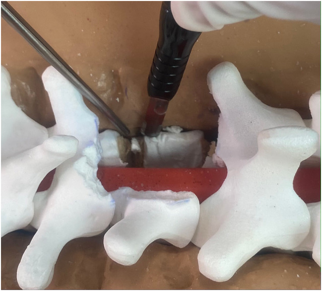 Transthoracic Approach Spine — Fig. 1