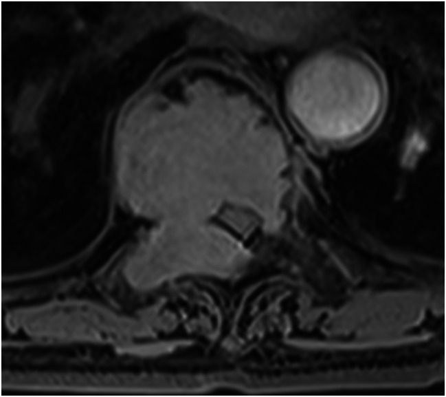 Transthoracic Approach Spine — Fig. 3