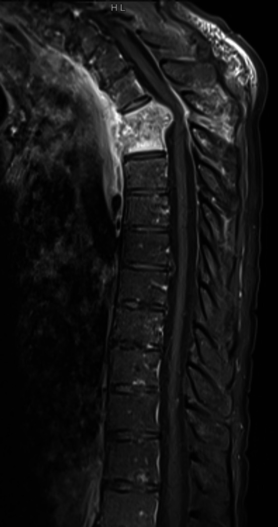 Transthoracic Approach Spine — Fig. 5