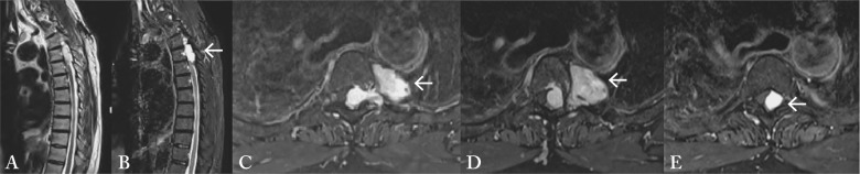 Transthoracic Approach Spine — Fig. 1