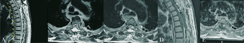 Transthoracic Approach Spine — Fig. 3