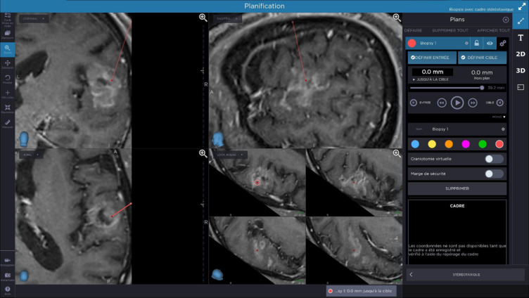 Reference Brain Biopsy Systems Stereotactic Platforms — Fig. 1