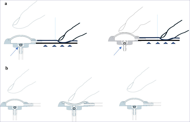 Reference CSF Shunt Systems, Types, Valves — Fig. 1