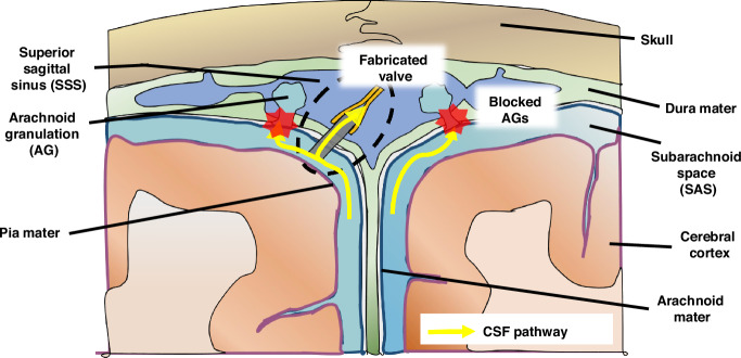 Reference CSF Shunt Systems, Types, Valves — Fig. 1