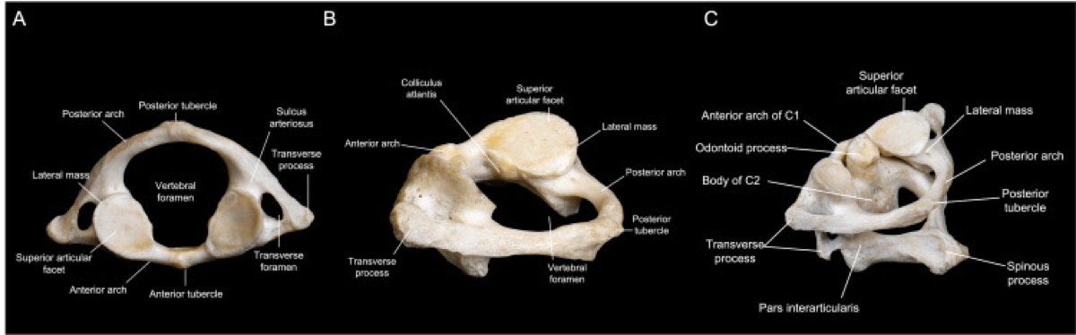 C1 (atlas) anatomy — transverse foramina, posterior arch, and the vertebral-artery groove