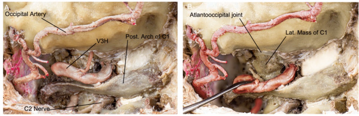 Craniocervical junction after muscle dissection — occipital condyle–C1 articulation & VA