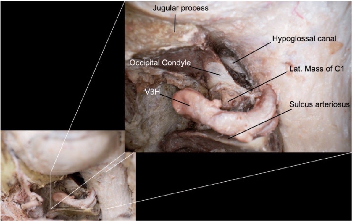 Transcondylar detail after posterior-third condylectomy — the hypoglossal canal marks the medial limit, with the C0–C1 joint preserved