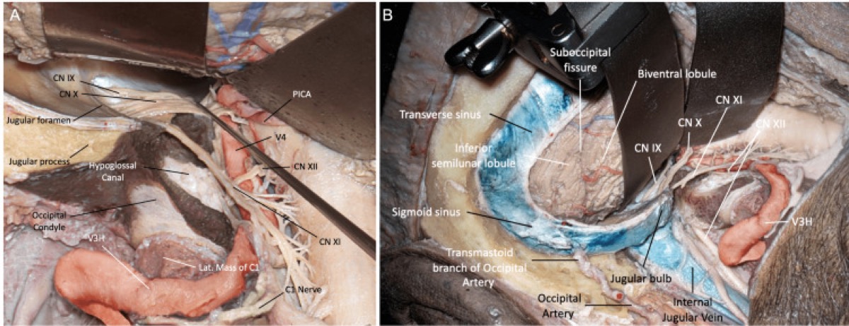 Far-lateral modifications — supracondylar (jugular tubercle) and paracondylar extensions