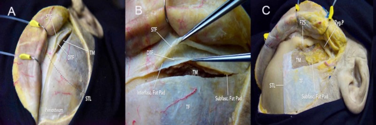 Fascial dissection planes (intrafascial vs subfascial) protecting the frontotemporal branch of the facial nerve