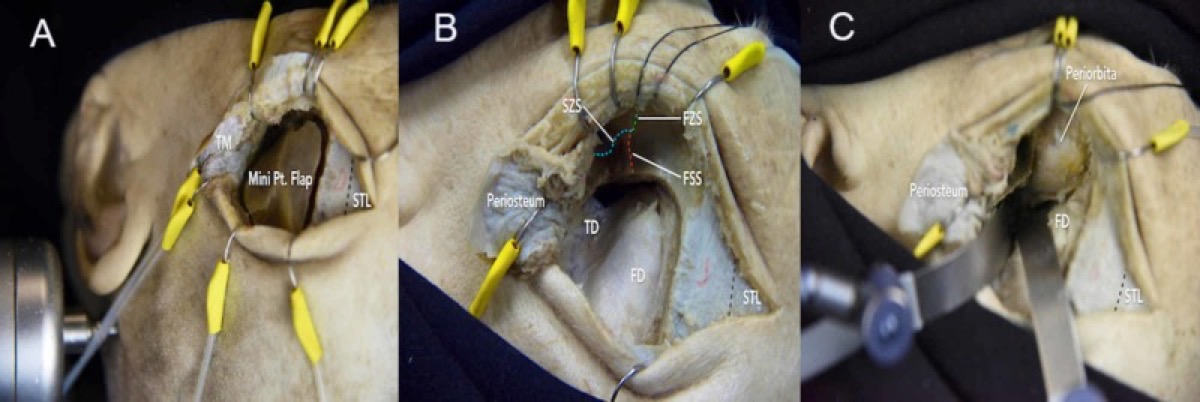 Mini-orbitozygomatic — MacCarty keyhole craniotomy with a limited orbital bar