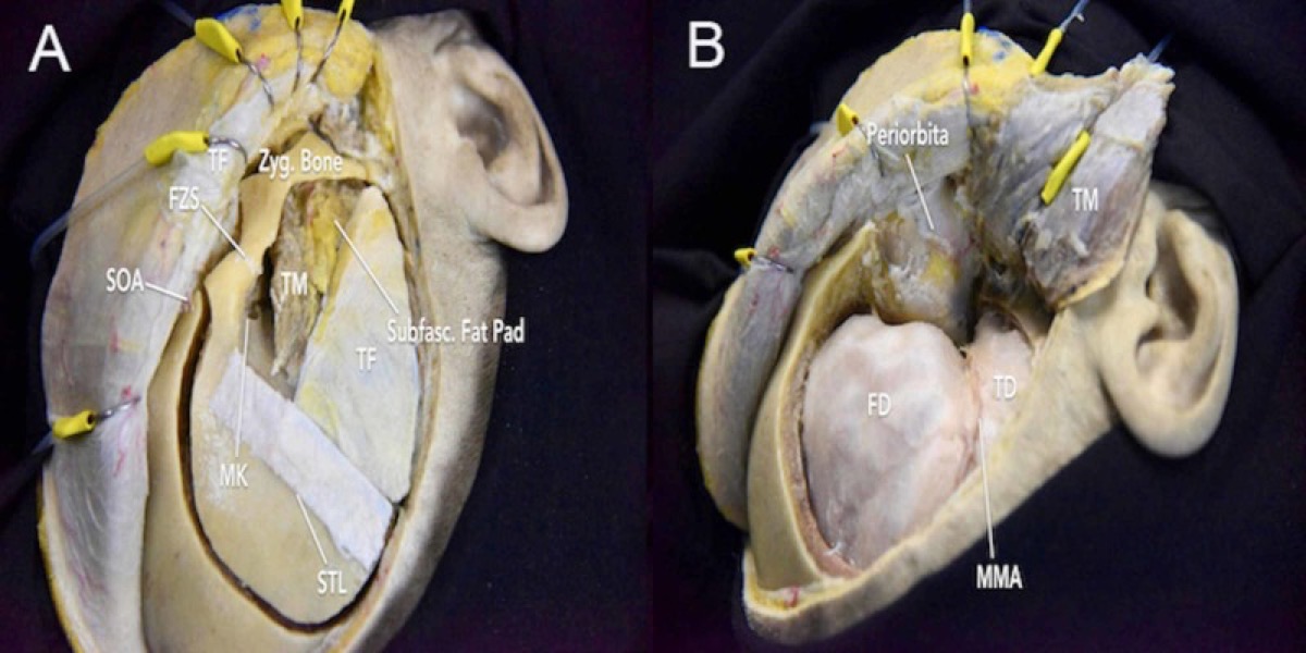 One-piece FTOZ: burr-hole placement and the single osteotomy unit / exposure window