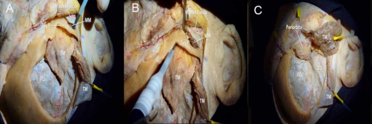 Three-piece FTOZ — pterional flap, zygomatic arch cut, and the orbital bar