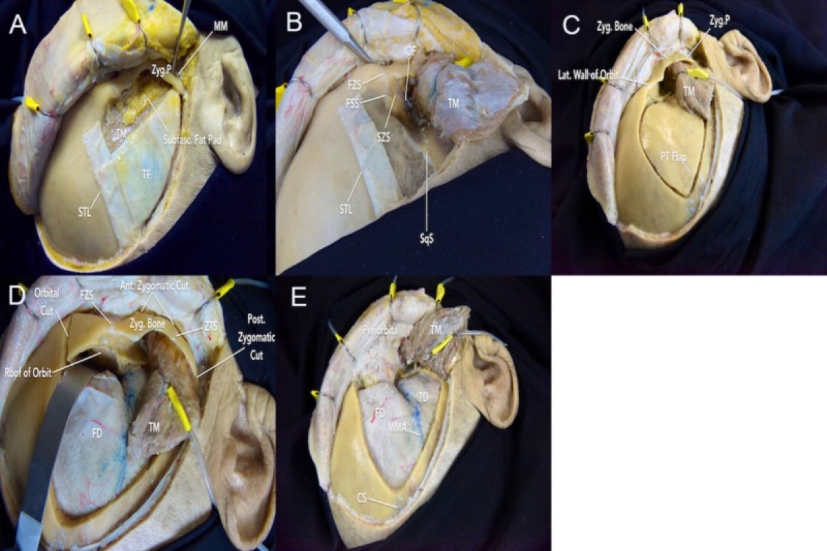 Two-piece FTOZ: temporalis reflection, periorbita exposure, pterional flap, and the orbital/zygomatic cuts that free the bar