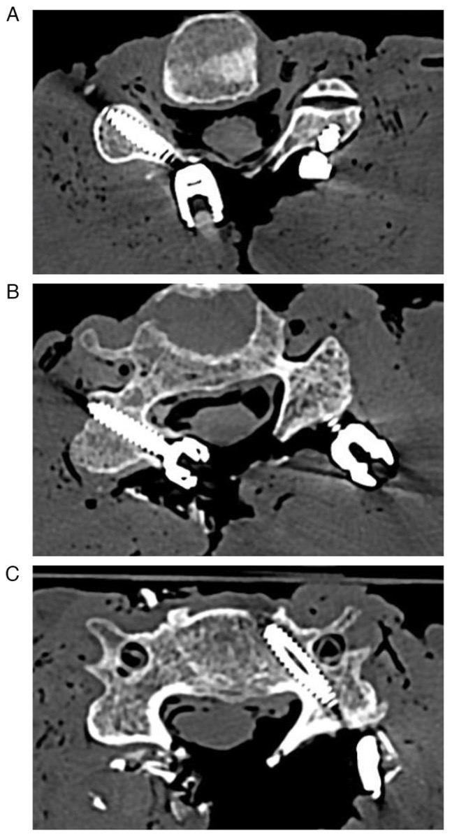 Axial CT (cadaver) — lateral mass screw trajectory at C4 (left), contrasted with a longer bicortical screw variant (right)