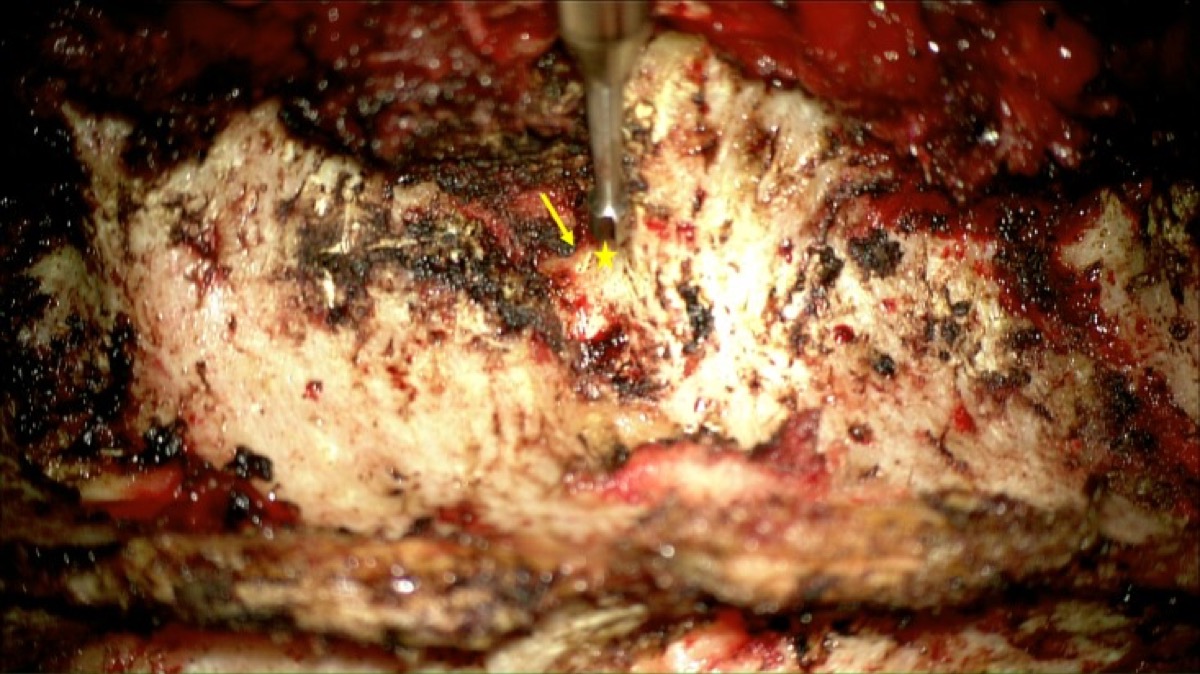 Pedicle entry point (star) just caudal to the SAP–transverse-process junction; high-speed drill marks the start