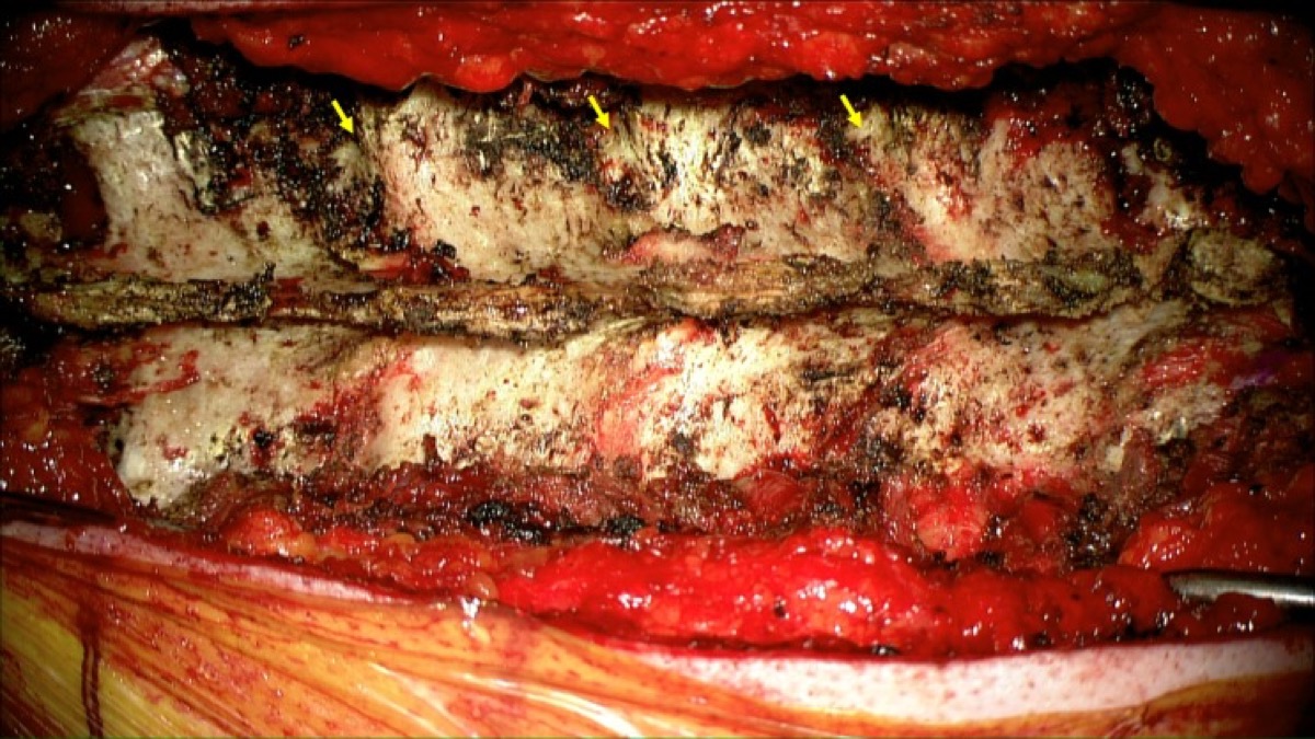 Thoracic exposure — lateral edge of the superior articular process & transverse process (entry landmarks)