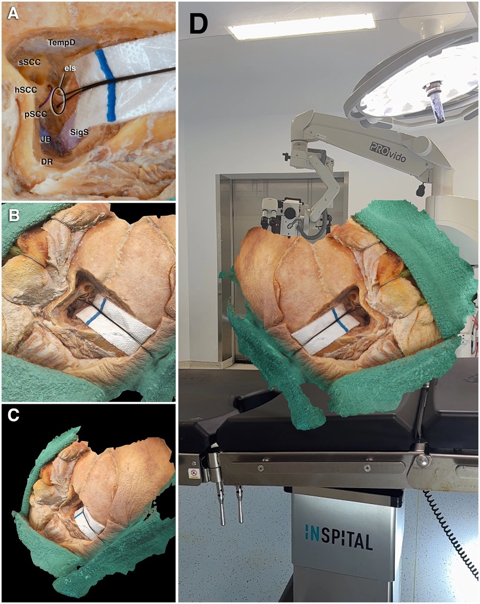 3D temporal-bone model — labyrinth, cochlea, jugular bulb, sigmoid sinus