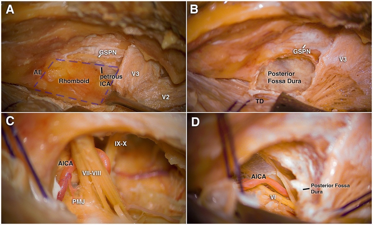 Anterior transpetrosal (Kawase) drilling — GSPN, rhomboid, posterior-fossa dura, and the CN VII–VIII complex