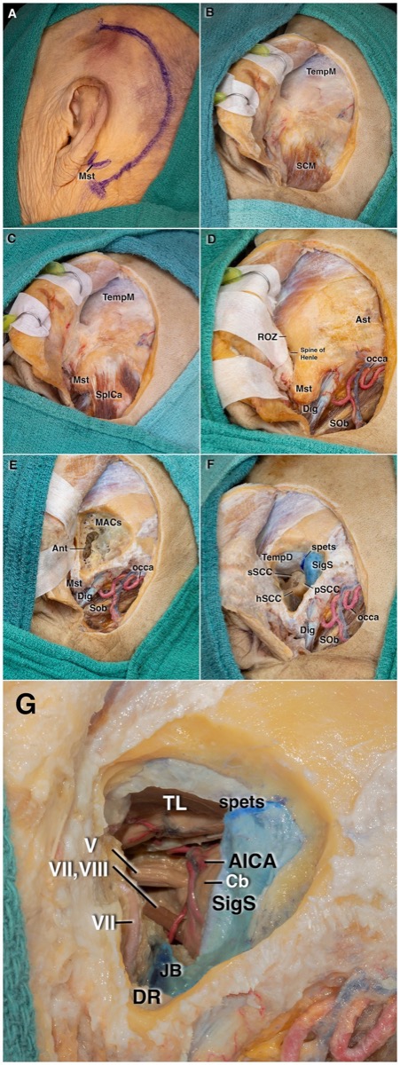 Stepwise translabyrinthine/retrolabyrinthine petrous drilling — mastoid, semicircular canals, labyrinthectomy, and CPA exposure