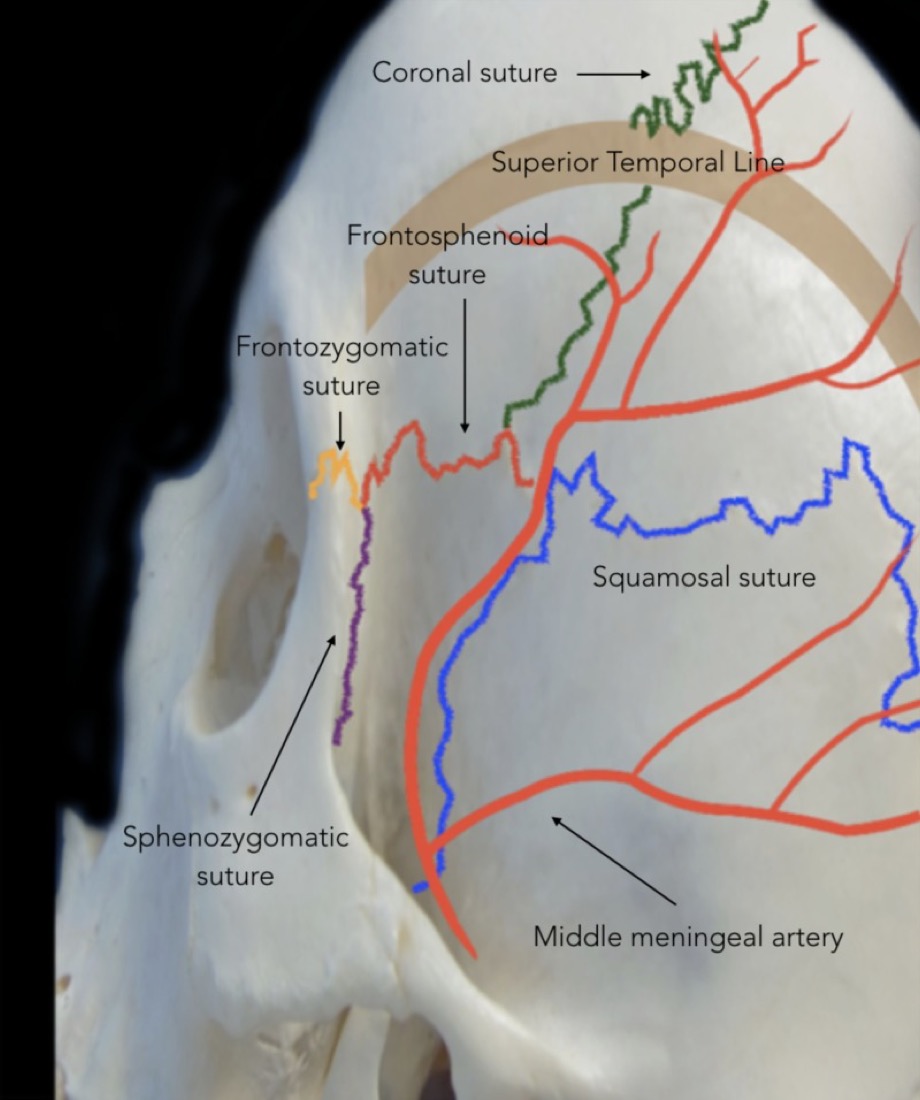 Lateral skull — course of the middle meningeal artery beneath the pterion (encountered as the wing is removed)