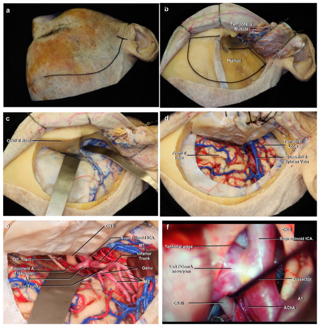 Pterional approach overview — positioning, bone removal, dural opening, and intradural neurovascular exposure (ICA, MCA)