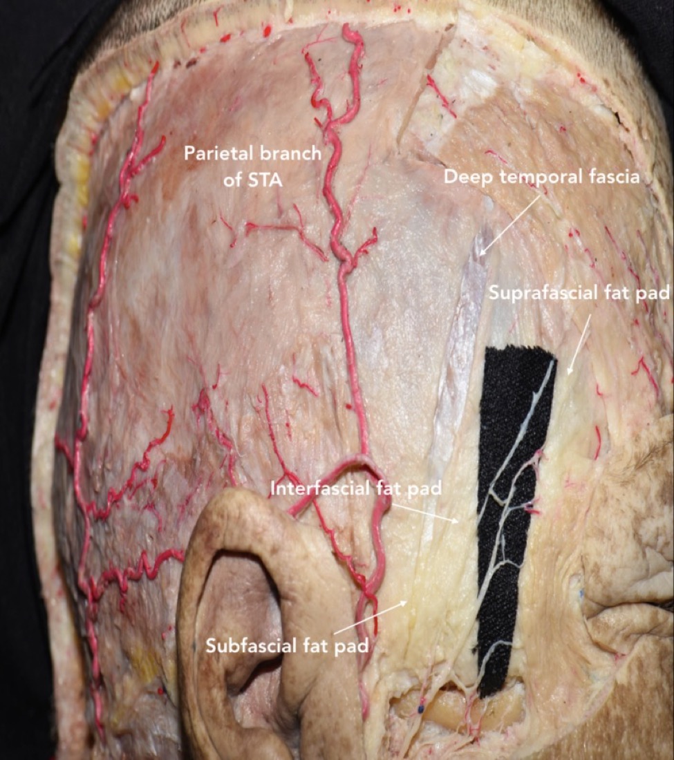 Scalp & temporal fascial layers — galea, temporoparietal fascia, superficial temporal fat pad, deep temporal fascia, pericranium