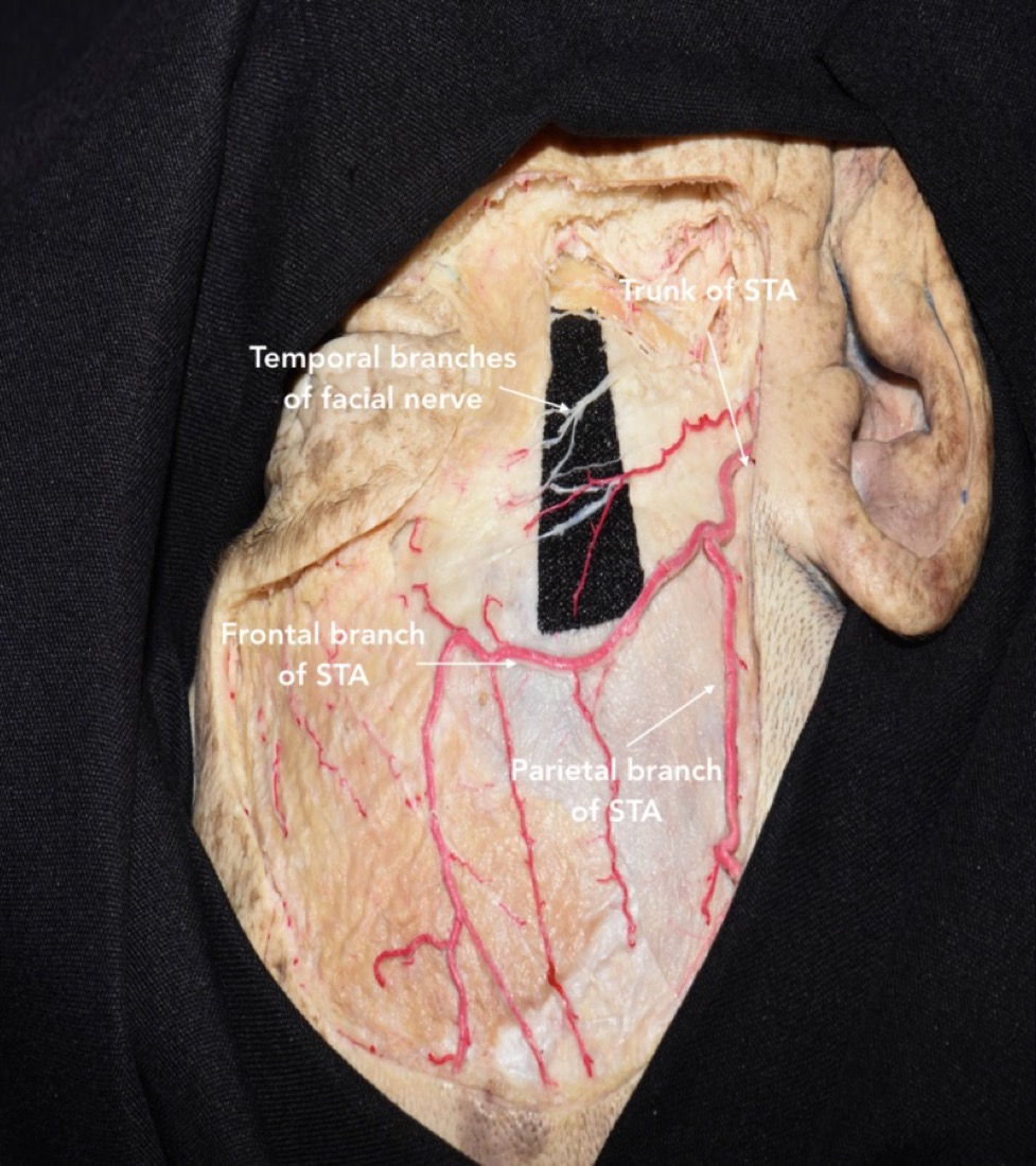 Superficial temporal artery & the frontotemporal (frontalis) branches of the facial nerve coursing over the fat pad