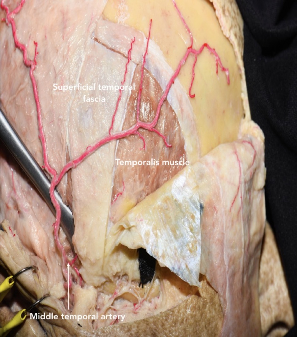 Temporalis dissection (interfascial / Oikawa technique) carrying the fat pad and facial-nerve branches with the flap
