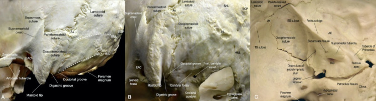 Osseous anatomy of the retrosigmoid region — lateral skull, posterior fossa, petrous face
