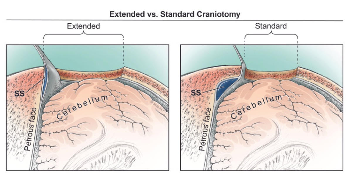 Standard vs extended retrosigmoid corridors (sigmoid/transverse sinus skeletonization)